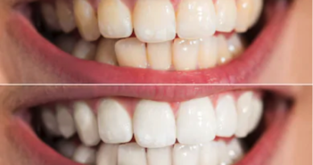 teeth whitening dental care