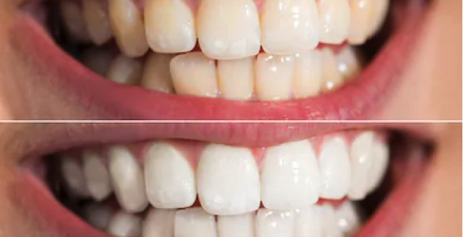 teeth whitening dental care