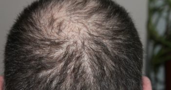 Solution to Hair Loss - healthier hair for men
