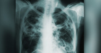 lung cancer