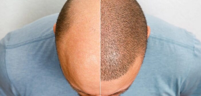hair transplant