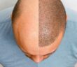 hair transplant