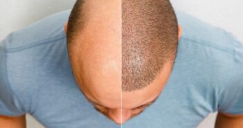 hair transplant