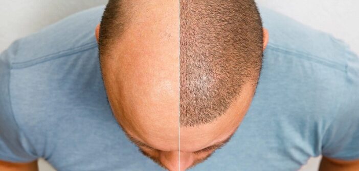 hair transplant