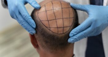 Hair transplants in the North West