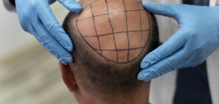 Hair transplants in the North West