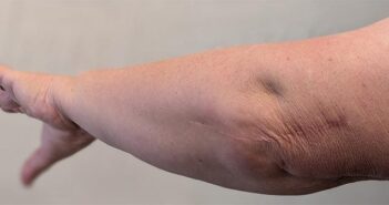 elbow